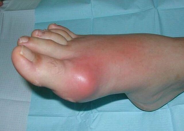 Klinikinis pėdos artrito vaizdas – patinimas ir uždegimas