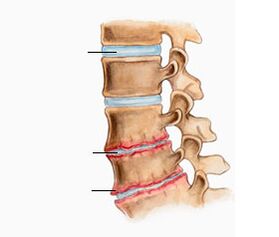 Osteochondrozė