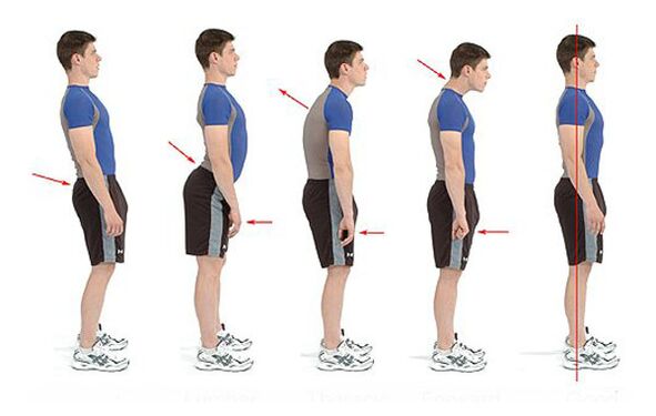 Osteochondrozės prevencija