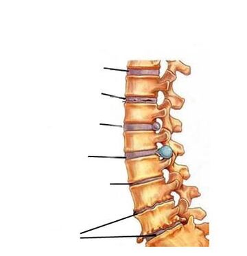 Osteochondrozės vystymosi stadijos