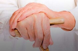 reumatoidiniu artritu sergančių pirštų sąnarių skausmas
