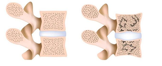 osteoporozė - kalcio pašalinimas iš kaulų