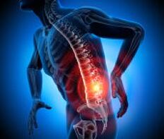 įvairių nugaros skausmų priežasčių