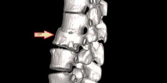stuburo patologija kaip nugaros skausmo priežastis
