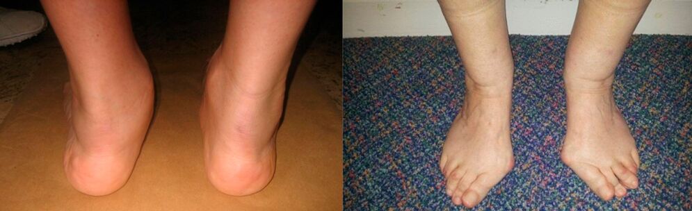 Kojos piršto artrozė ir deformuojanti čiurnos artrozė