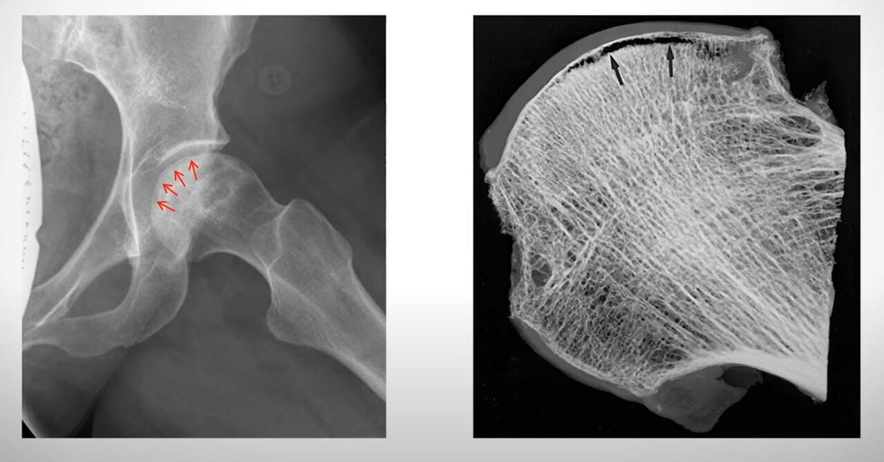 Aseptinės nekrozės paveiktos šlaunikaulio galvos rentgeno nuotrauka