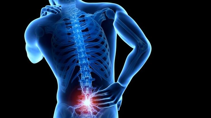 nugaros skausmas su juosmens osteochondroze